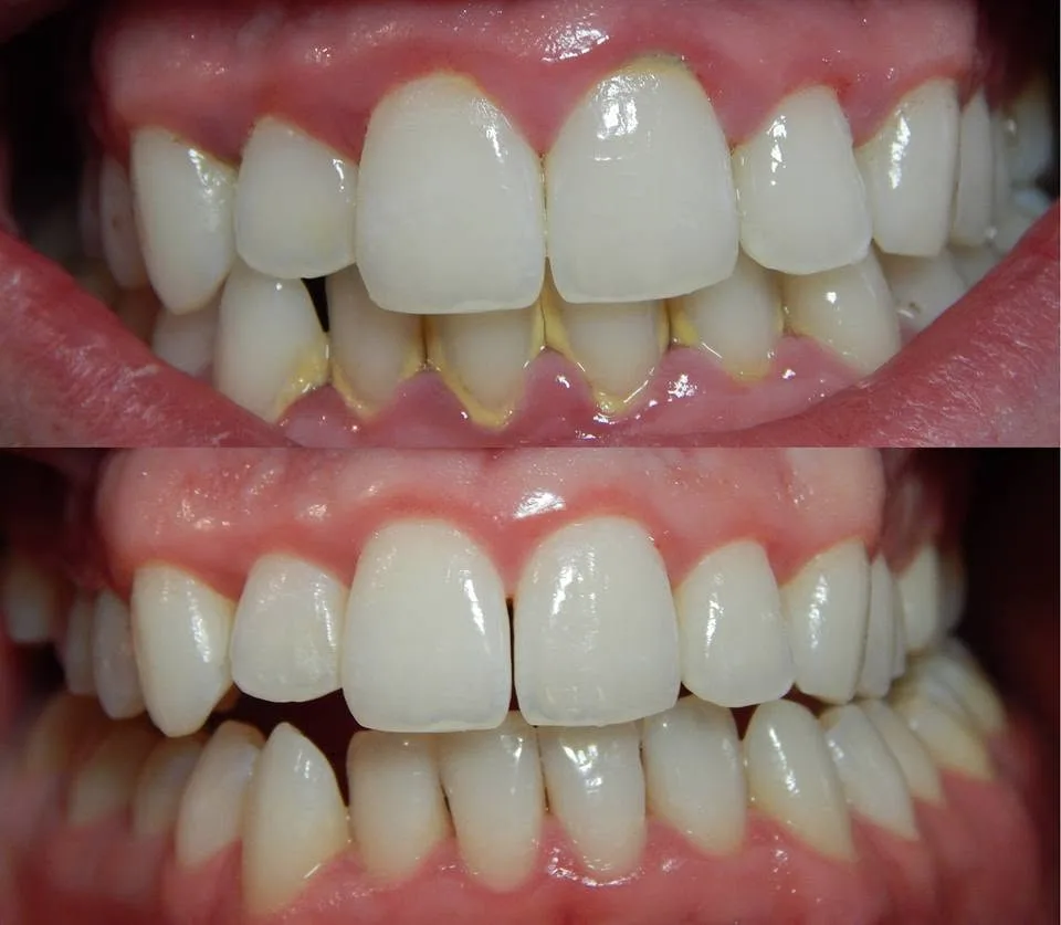 Teeth whitening before and after result