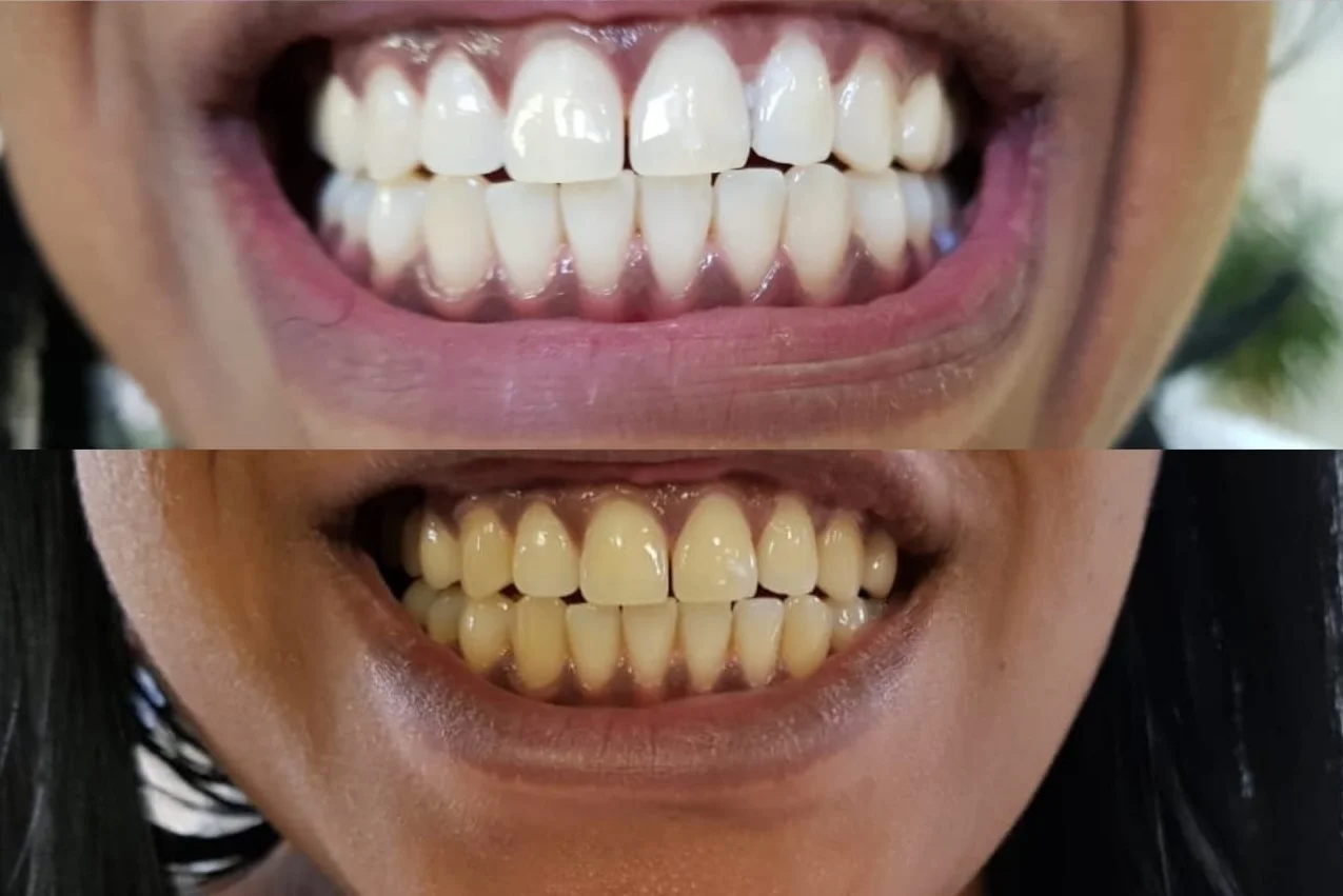 Teeth whitening before and after result