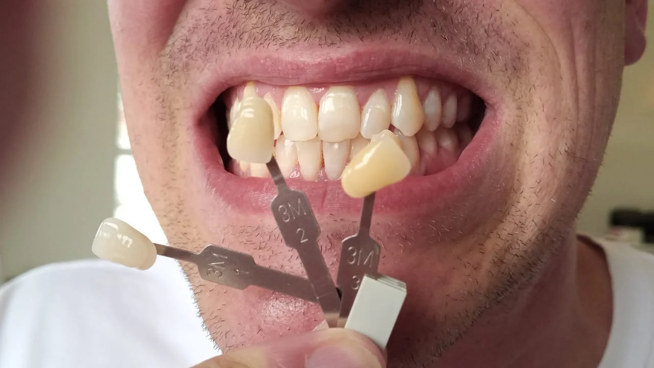 Teeth whitening before and after result
