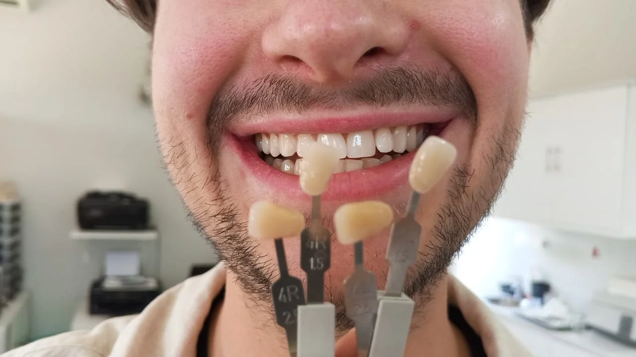 Teeth whitening before and after result