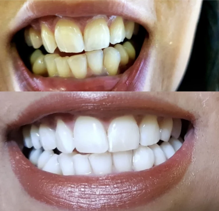 Teeth whitening before and after