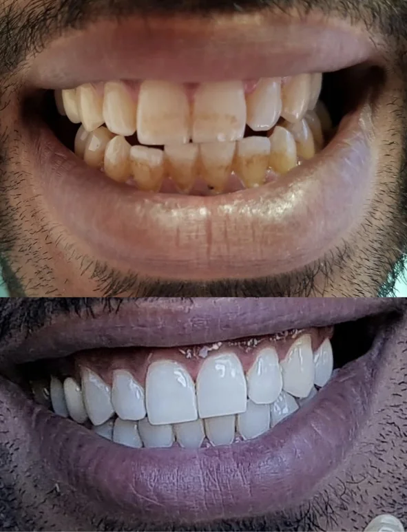 Teeth whitening before and after result