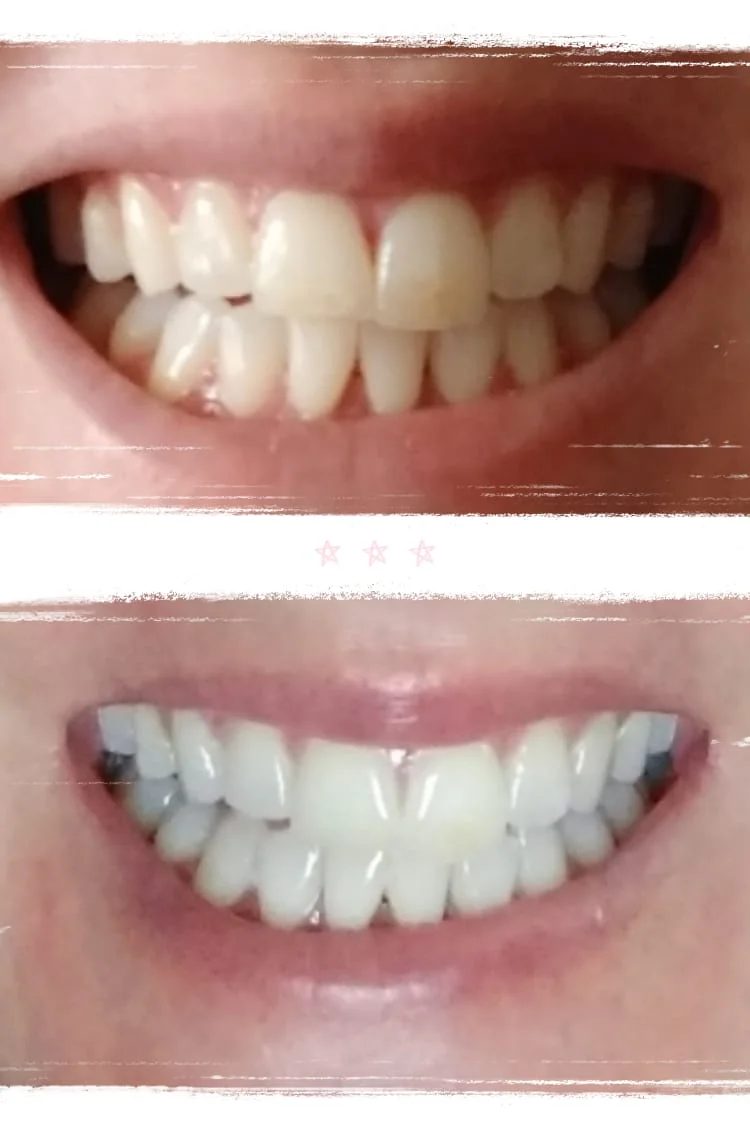 Teeth whitening result