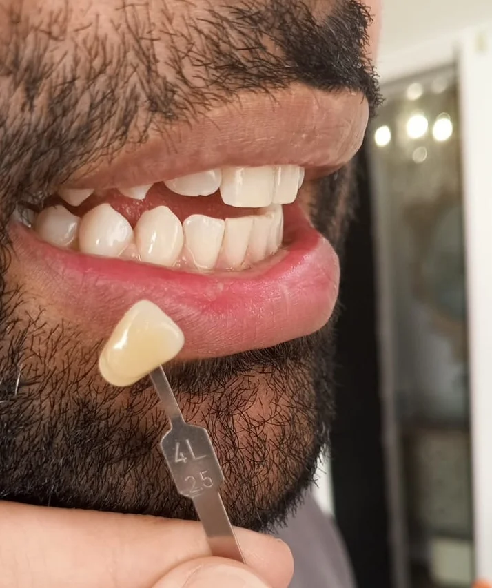Teeth whitening before and after result