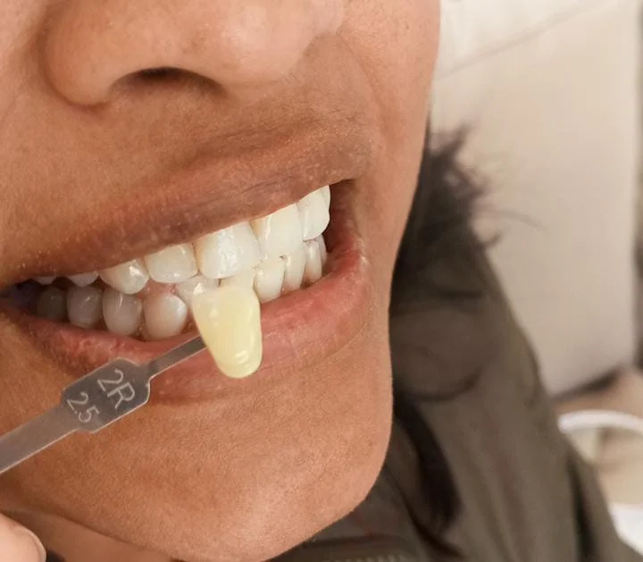 Teeth whitening before and after result